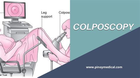 colposcopy price philippines|√ 2024 Endoscopy Price List and Cost Philippines .